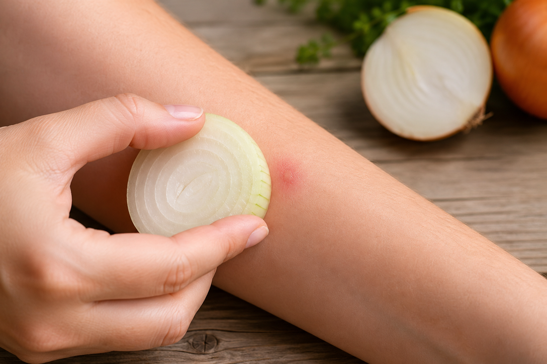 Fresh onion being applied to a bee or wasp sting as a traditional home remedy.